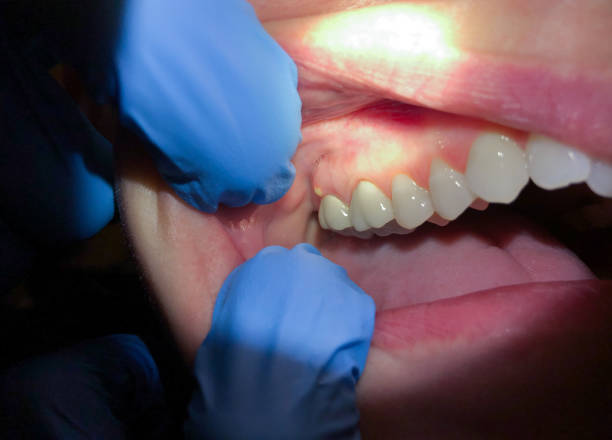 Best Emergency Dental Extractions in Haltom City, TX