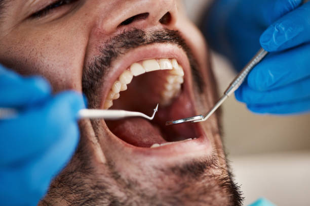Best Emergency Dentist for Lost Fillings or Crowns in Haltom City, TX